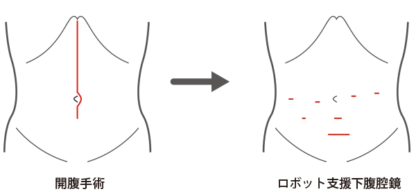 図1：従来の開腹手術とロボット手術の創（きず）の違い