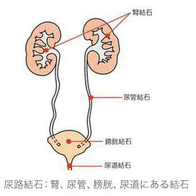 1.尿路結石とは?