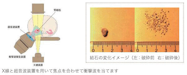 2.体外衝撃波結石破砕治療 (ESWL:Extracorporeal Shock Wave Lithotripsy)とは?