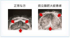 2.前立腺肥大症とは?
