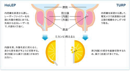 HoLEPとTUR-Pの違い~イメージ比較
