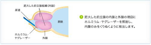30歳で一般的にEDです