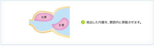 HoLEP治療の手順