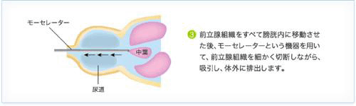 HoLEP治療の手順