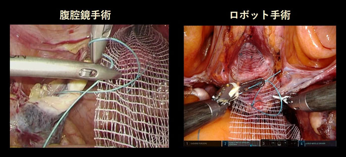 腹腔鏡手術とロボット手術の様子