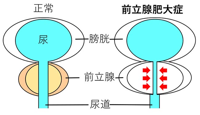 ウロリフト