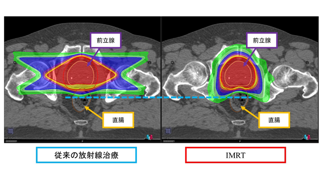 IMRT（強度変調放射線治療）の導入