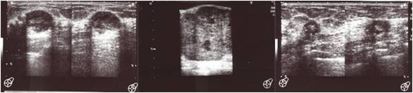 乳腺超音波検査で確認された腫瘤画像
