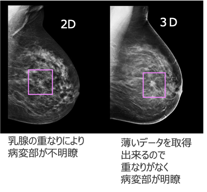 従来の2D画像のみでは見づらかった病変も3Dマンモグラフィ(トモシンセシス)を追加することで発見できる可能性が高くなります。