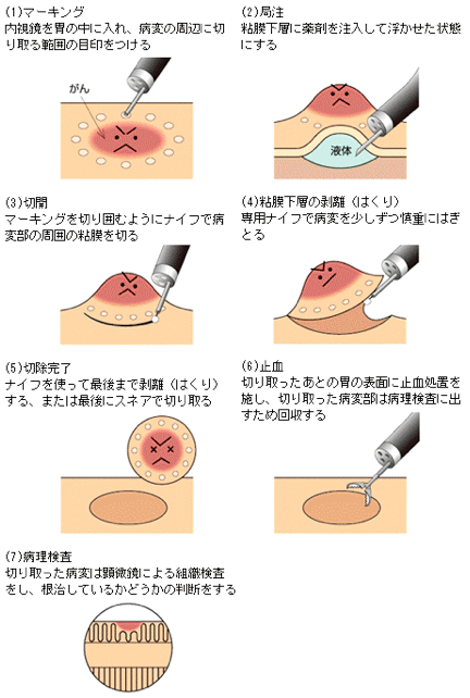 《ESDの手技》