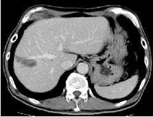 腫瘍部分は黒く焼灼され壊死している