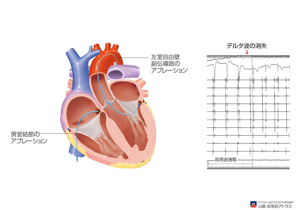 不整脈：循環器内科 | 上尾中央総合病院