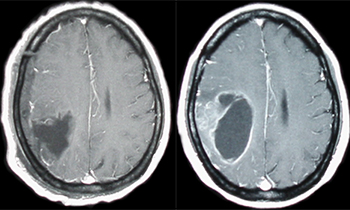 神経膠腫の検査画像