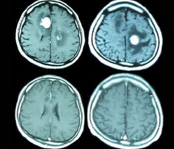 脳の悪性リンパ腫の検査画像
