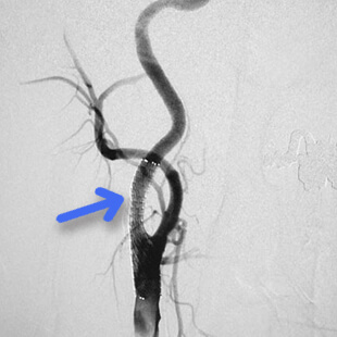 頸動脈ステント留置術②