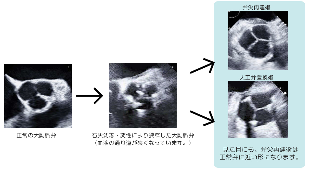 大動脈弁の正常と狭窄