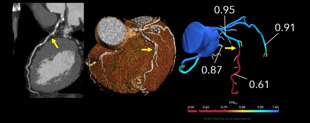 FFR-CT での検査画像