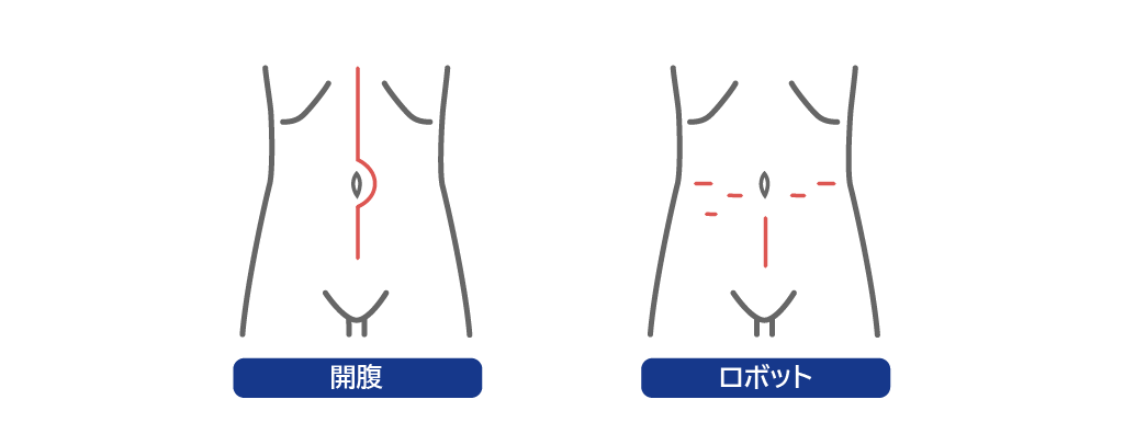 従来の開腹手術とロボット手術の創（きず）の違い