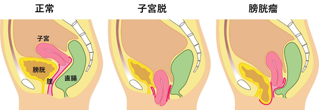 骨盤臓器脱