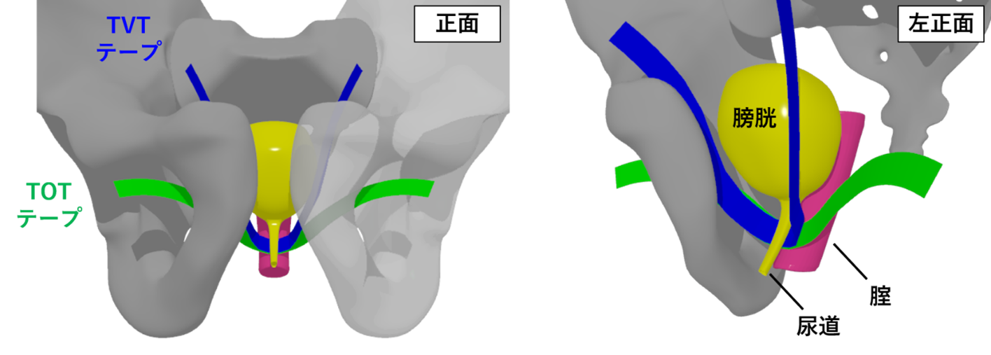 腹圧性尿失禁：尿道スリング手術：泌尿器科 | 上尾中央総合病院