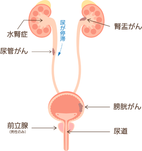 尿路に発生するがんの位置を示す図。腎盂がん、尿管がん、膀胱がんが描かれており、尿管がんによって尿の流れが妨げられ、水腎症が起こっている様子も示されている。前立腺は男性のみに存在することが注記されている。